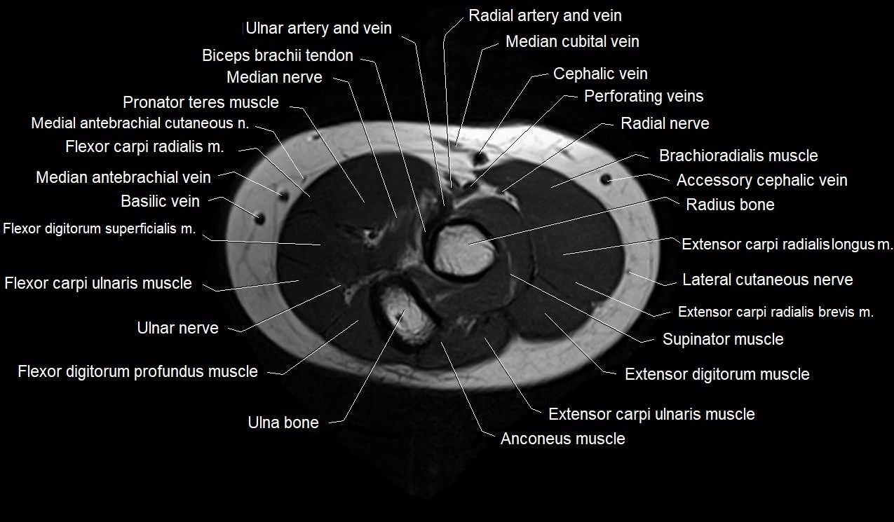 MRI 3T forearm axial cross sectional anatomy image 11.webp